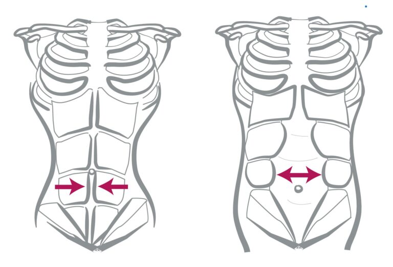 diastasi addominale, come si cura, cos'è, trattamenti