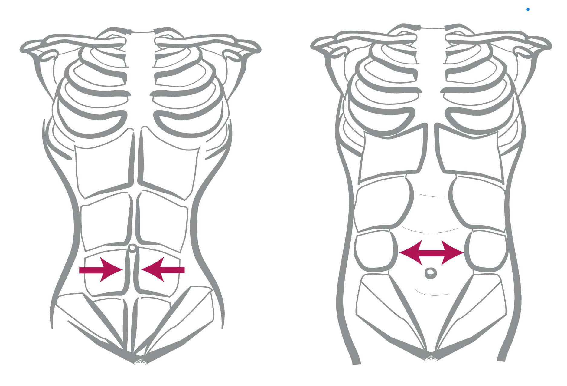 diastasi addominale, come si cura, cos'è, trattamenti